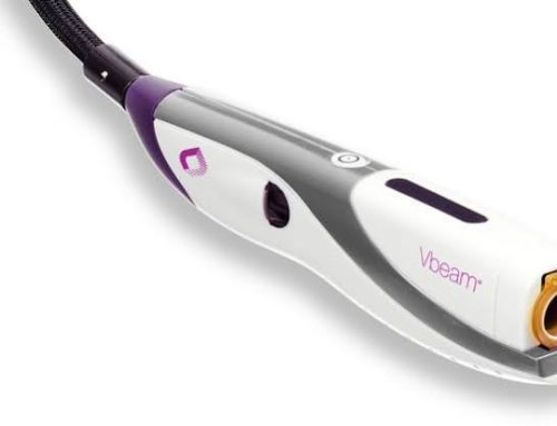VBeam Pulsed Dye Laser (PDL): What It Is and What to Expect