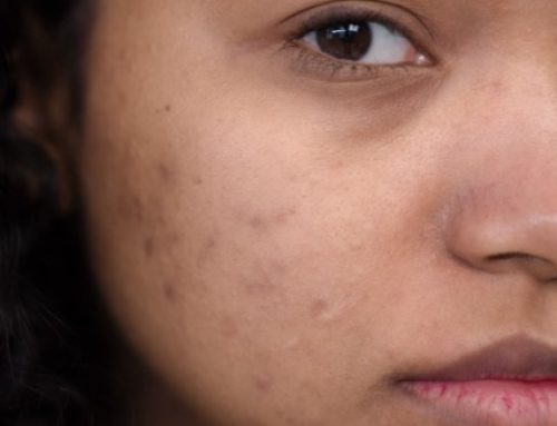 Hydroquinone-Induced Ochronosis: When Skin Lightening Backfires